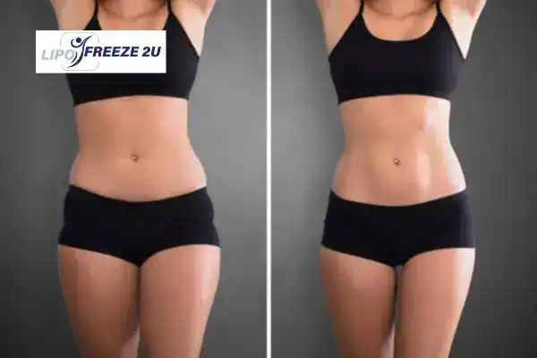 How Can LIPO FREEZE 2U Support Your Post-Pregnancy Body Recovery Godalming?