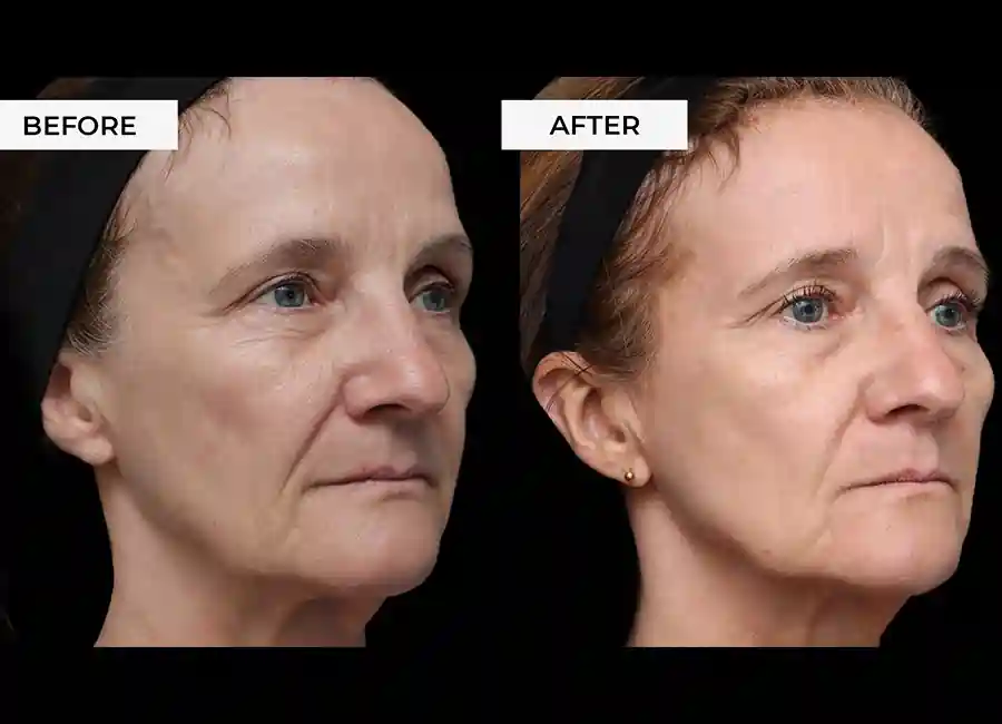 How Many RF Microneedling Sessions Will You Need to See a Difference Godalming?