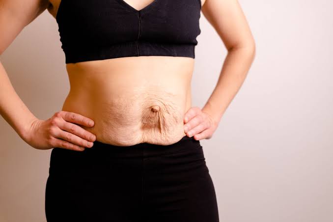 Is Surgery Really the Only Way to Repair Diastasis Recti Godalming?
