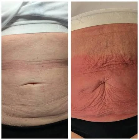 How Does RF Microneedling Improve Crepey, Thin and Uneven Skin Texture Godalming?