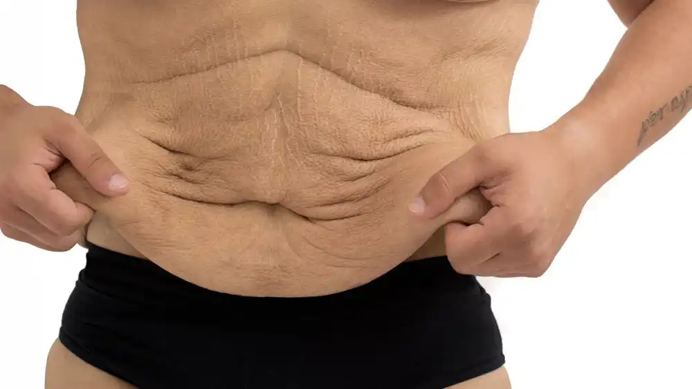 RF Microneedling for Loose Skin: How Can It Help Tighten and Reshape the Skin Godalming?